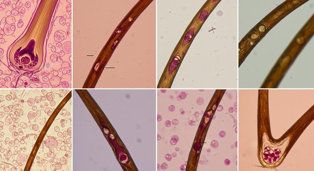 How to Identify Hair Shaft Disorders Naturally at Home