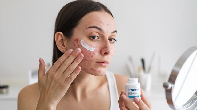 Does Tretinoin Help with Acne Scars? Detailed Insights